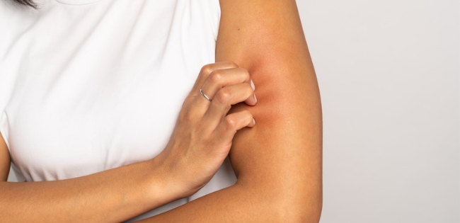 vrouw krabt aan haar arm door huidirritatie